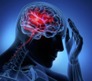 Read more about the article Video – A person having a stroke